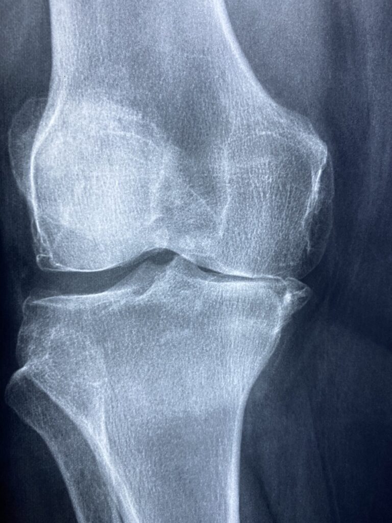 knee, x rays, arthritis, pain