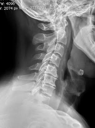 Cervicalspondylosis.jpg