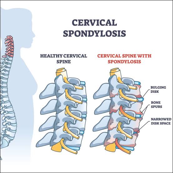 Cervicalspondylosis.jpg