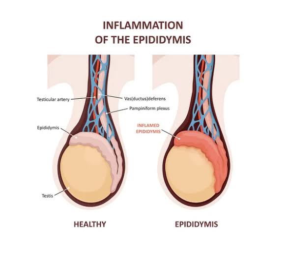 Epididymitis.jpg