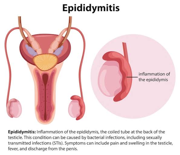 Epididymitis.jpg