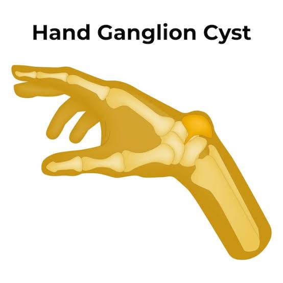 Ganglioncyst.jpg