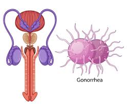 Gonorrhea.jpg