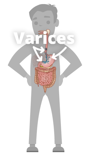 Esophagealvarices.jpg