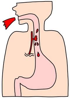 Esophagealvarices.jpg