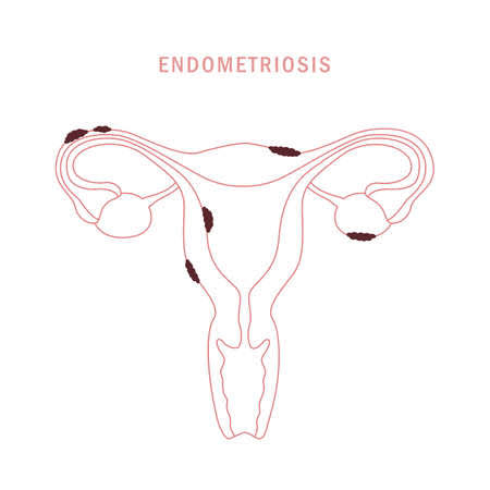 Endometriosis.jpg