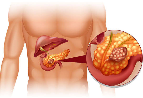 Pancreatitis.jpg