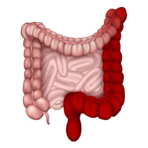 Ulcerativecolitis.jpg